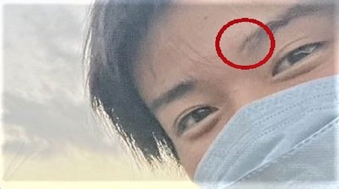 目黒蓮バク転でケガ!眉毛と鼻骨が傷ついてもやり続ける理由とは？