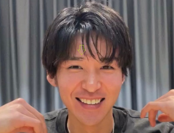 【画像】目黒蓮バク転でケガ！眉毛と鼻骨が傷ついてもやり続ける理由とは？